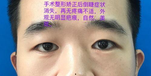 睑内翻矫正术手术视频,睑内翻矫正术手术过程详解