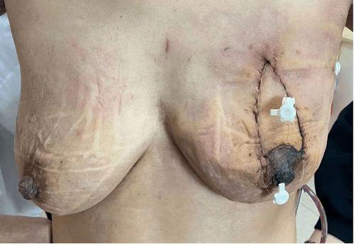 乳房再造视频,从手术到康复的美丽蜕变之旅